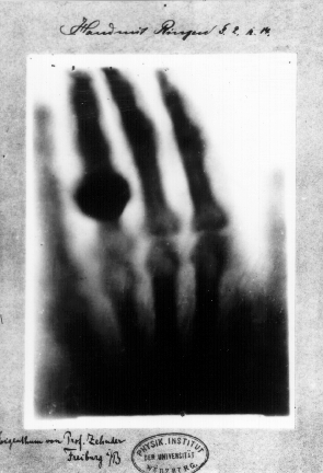 First medical X ray by Wilhelm Rontgen of his wife Anna Bertha Ludwigs hand 18951222