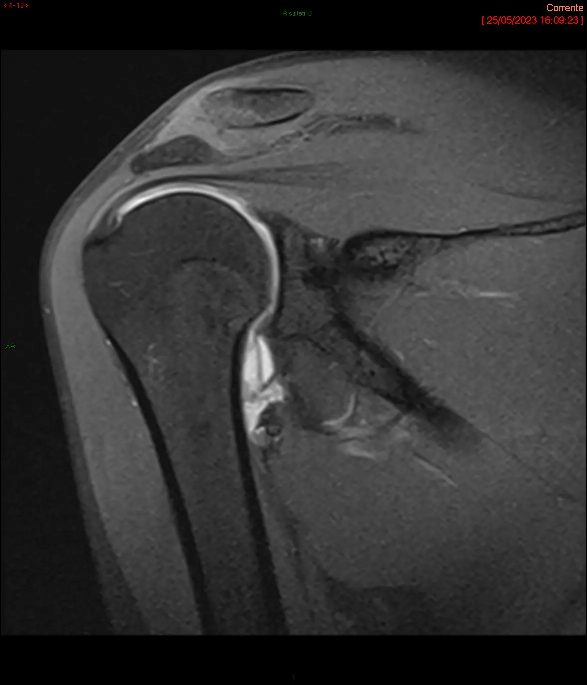 Instabilità della spalla 6 Strappo della capsula articolare sul versante omerale(HAGL)