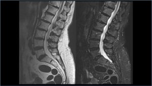 spinemri