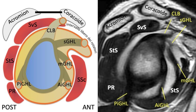 Come Diagnosticare l’Instabilità di Spalla: Lesioni e Imaging con Artro-RM 1 Immagine1