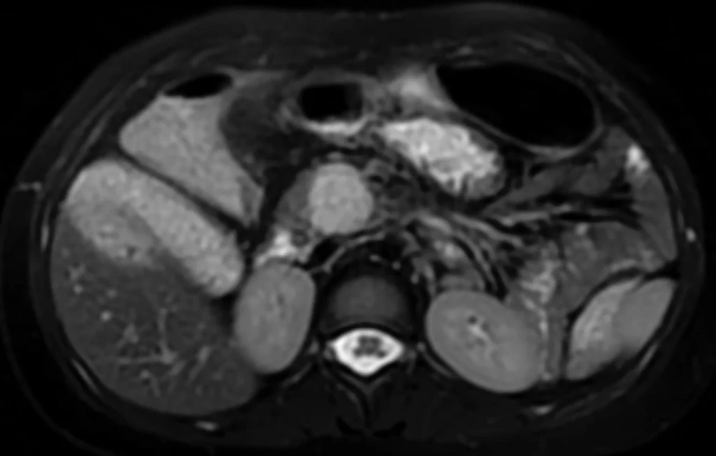 Lesioni cistiche del pancreas 18 SPEN Solid Pseudo Papillary Epithelial Neoplasm3