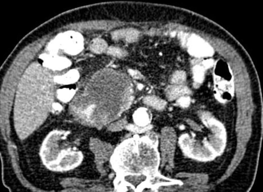 Lesioni cistiche del pancreas 19 adenoK a degenerazione cistica