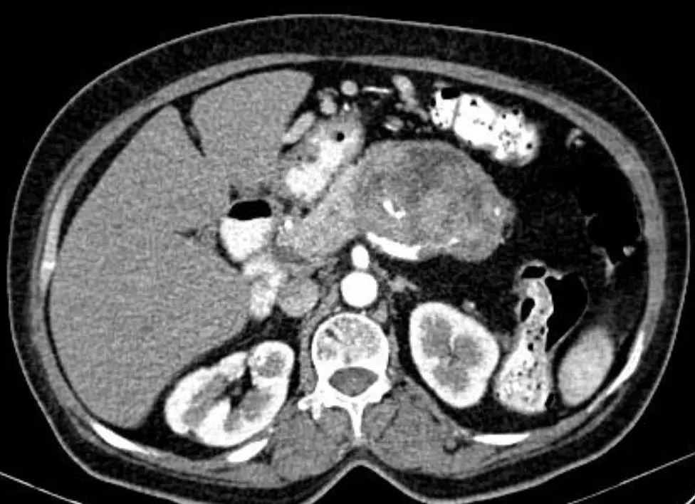 Lesioni cistiche del pancreas 15 cistoadeno carcinoma mucinoso