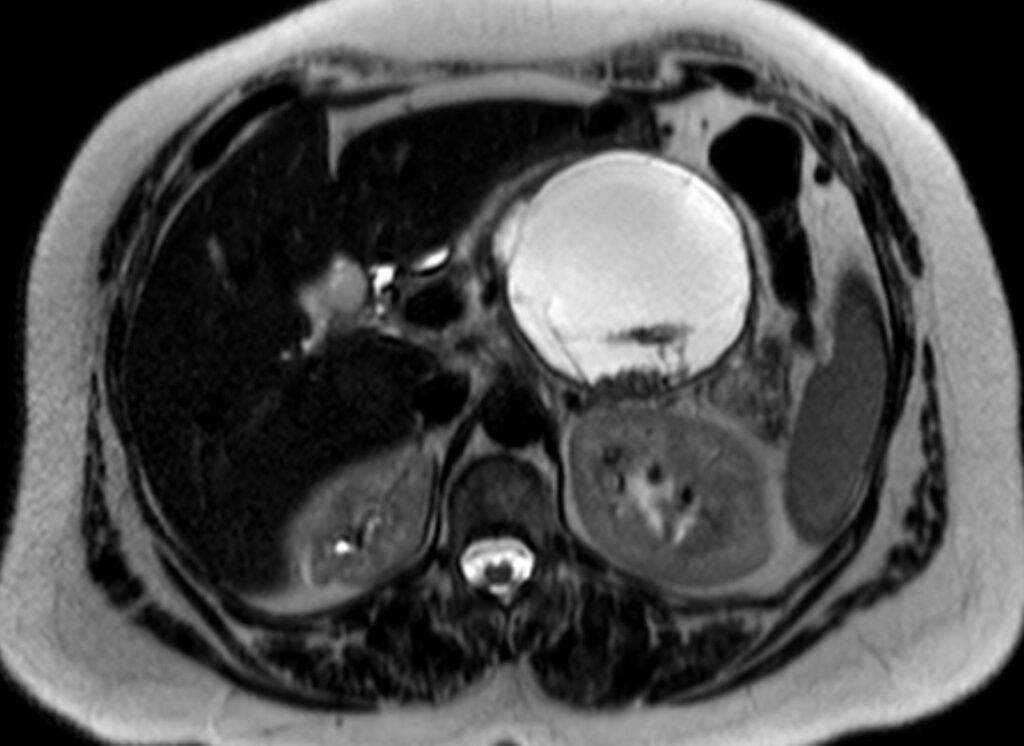 Lesioni cistiche del pancreas 14 cistoadenoma mucinos2