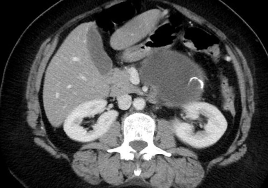 Lesioni cistiche del pancreas 13 cistoadenoma mucinoso