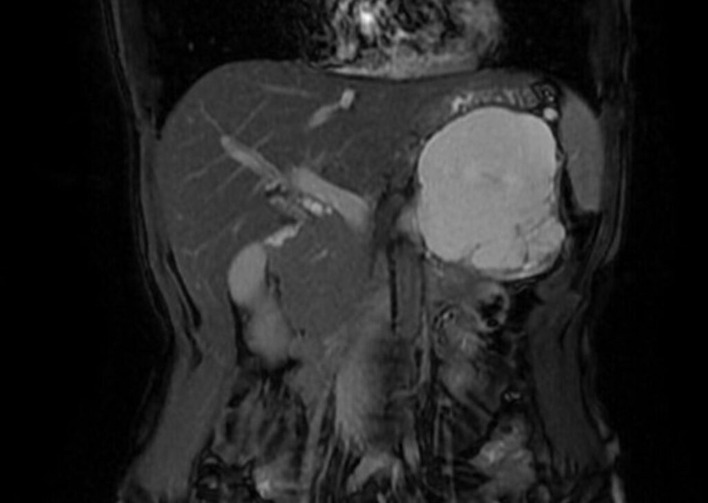 cistoadenoma sieroso.jpg