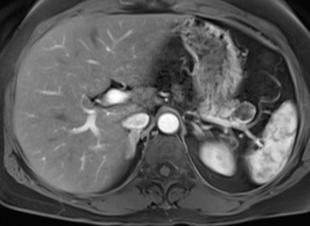 Lesioni cistiche del pancreas 20 net a degenerazione cistica