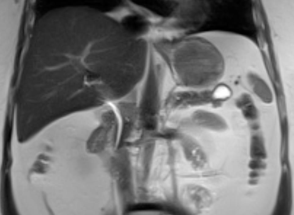 Lesioni cistiche del pancreas 21 net a degenerazione cistica2
