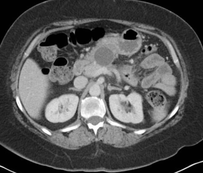 Lesioni cistiche del pancreas 2 pseudocisti