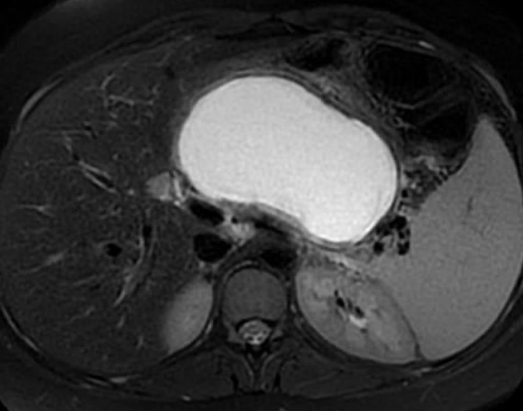Lesioni cistiche del pancreas 1 pseudocisti2