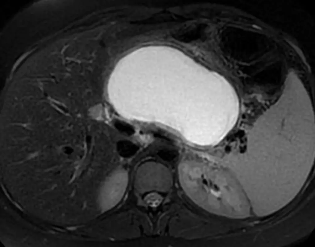 Lesioni cistiche del pancreas 1 pseudocisti2