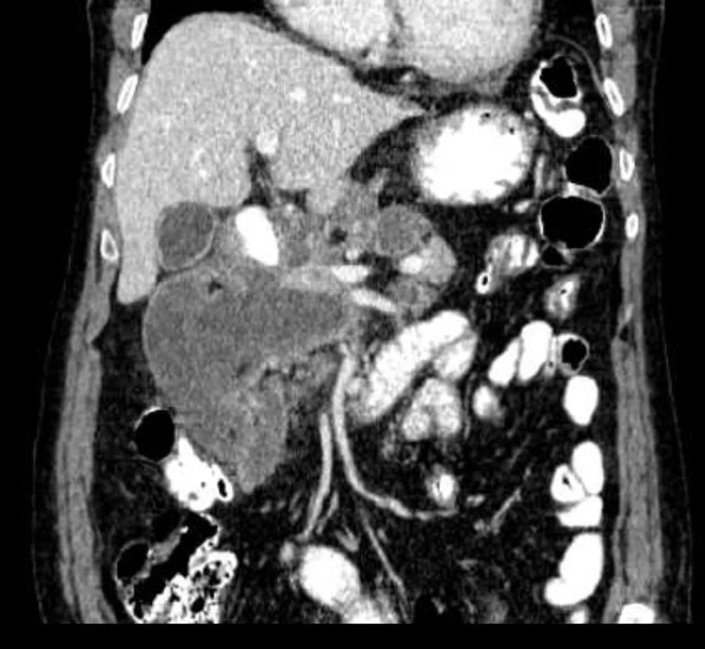 Lesioni cistiche del pancreas 3 pseudocisti3