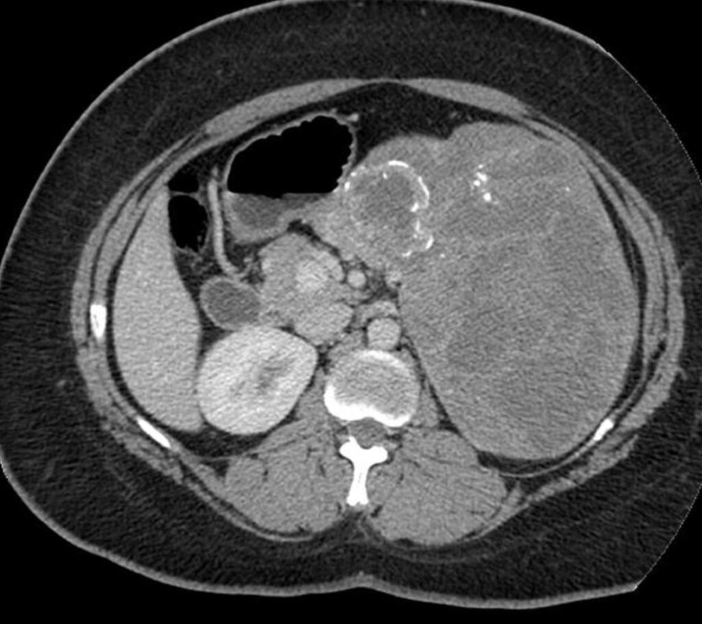 Lesioni cistiche del pancreas 16 spen
