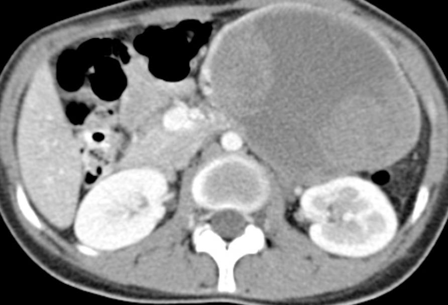 Lesioni cistiche del pancreas 17 spen 2