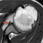 Come Diagnosticare l’Instabilità di Spalla: Lesioni e Imaging con Artro-RM 6 ALPSA