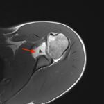 Come Diagnosticare l’Instabilità di Spalla: Lesioni e Imaging con Artro-RM 4 Bankart2
