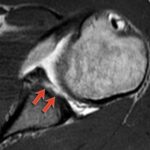 Come Diagnosticare l’Instabilità di Spalla: Lesioni e Imaging con Artro-RM 7 GLAD