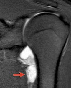 Come Diagnosticare l’Instabilità di Spalla: Lesioni e Imaging con Artro-RM 14 HAGL