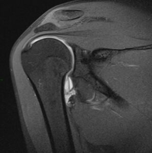 Come Diagnosticare l’Instabilità di Spalla: Lesioni e Imaging con Artro-RM 11 HAGL2