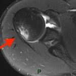 Come Diagnosticare l’Instabilità di Spalla: Lesioni e Imaging con Artro-RM 10 HS 1