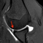 Come Diagnosticare l’Instabilità di Spalla: Lesioni e Imaging con Artro-RM 5 Perthes