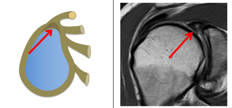 Come Diagnosticare l’Instabilità di Spalla: Lesioni e Imaging con Artro-RM 2 Progetto senza titolo e1747752317803