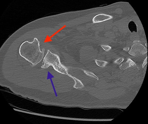 Come Diagnosticare l’Instabilità di Spalla: Lesioni e Imaging con Artro-RM 13 Reverse bony lesions