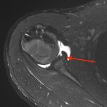 Come Diagnosticare l’Instabilità di Spalla: Lesioni e Imaging con Artro-RM 9 bony bankart