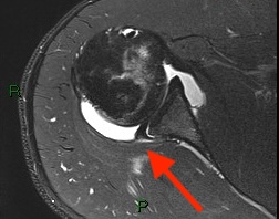 Come Diagnosticare l’Instabilità di Spalla: Lesioni e Imaging con Artro-RM 12 reverse bankart
