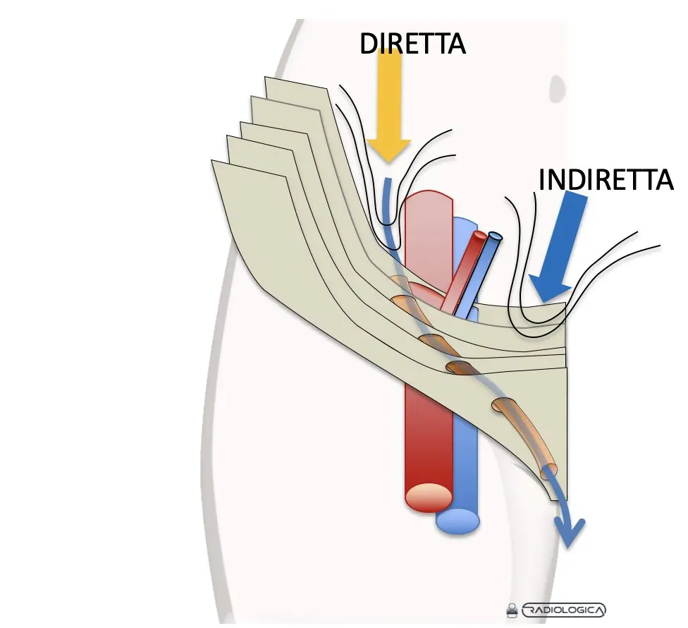 Ernia inguinale diretta e indiretta